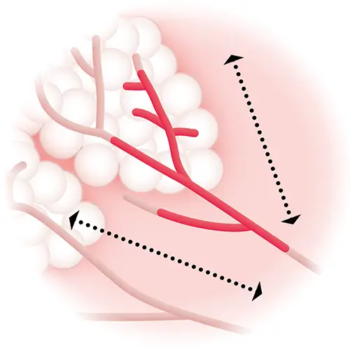 Dessin Arborescence galactophorique et progression des états précancéreux illustration Le Confluent 2