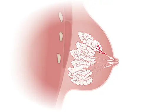 Dessin Arborescence galactophorique et progression des états précancéreux illustration Le Confluent