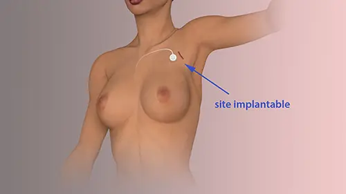 Dessin buste site implantable illustration Le Confluent